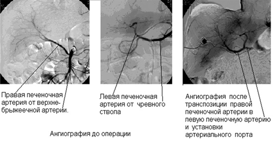 Вариант анатомии и реконструкция артерий печени для проведения эффективной длительной регионарной химиотерапии