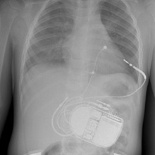 Редкий случай имплантации кардиовертера-дефибриллятора двухлетнему ребенку с высоким риском внезапной сердечной смерти