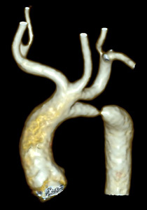 «Бычью дугу аорты» – редчайший порок сердца – успешно прооперировали детские кардиохирурги Центра Алмазова